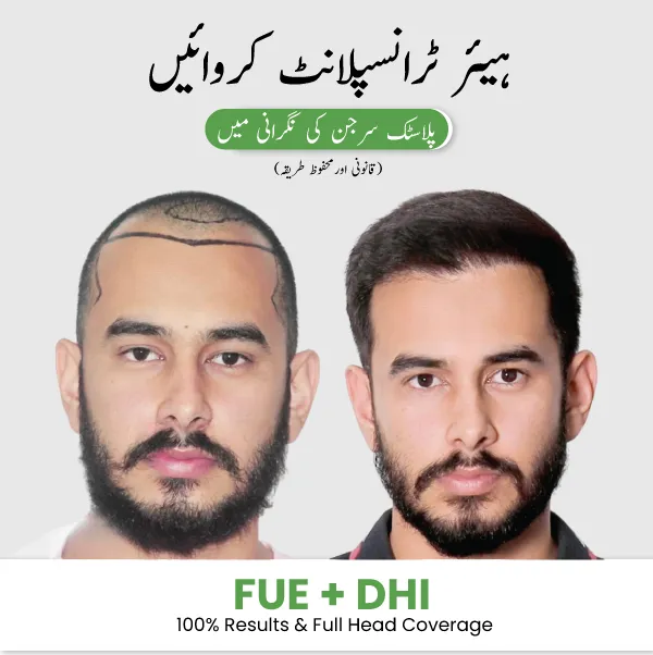 Hair transplant before and after results showing FUE DHI treatment with full head coverage