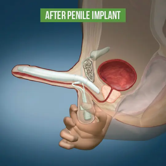 Six circular icons showing benefits of penile implants: improved intimacy and relationship satisfaction, restored confidence and self-esteem, spontaneity and readiness anytime, effective and reliable ED solution, permanent treatment without pills or injections, and discreet design not visible externally, with text noting high patient satisfaction rates