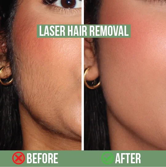 Facial cheek laser hair removal before and after on dark skin