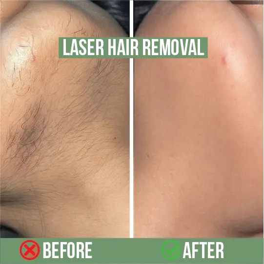 Chin laser hair removal before and after – smooth hairless skin