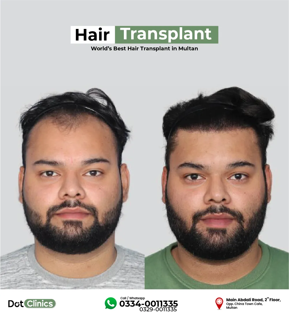 pakistani patient after 12 month of hair transplant surgery
