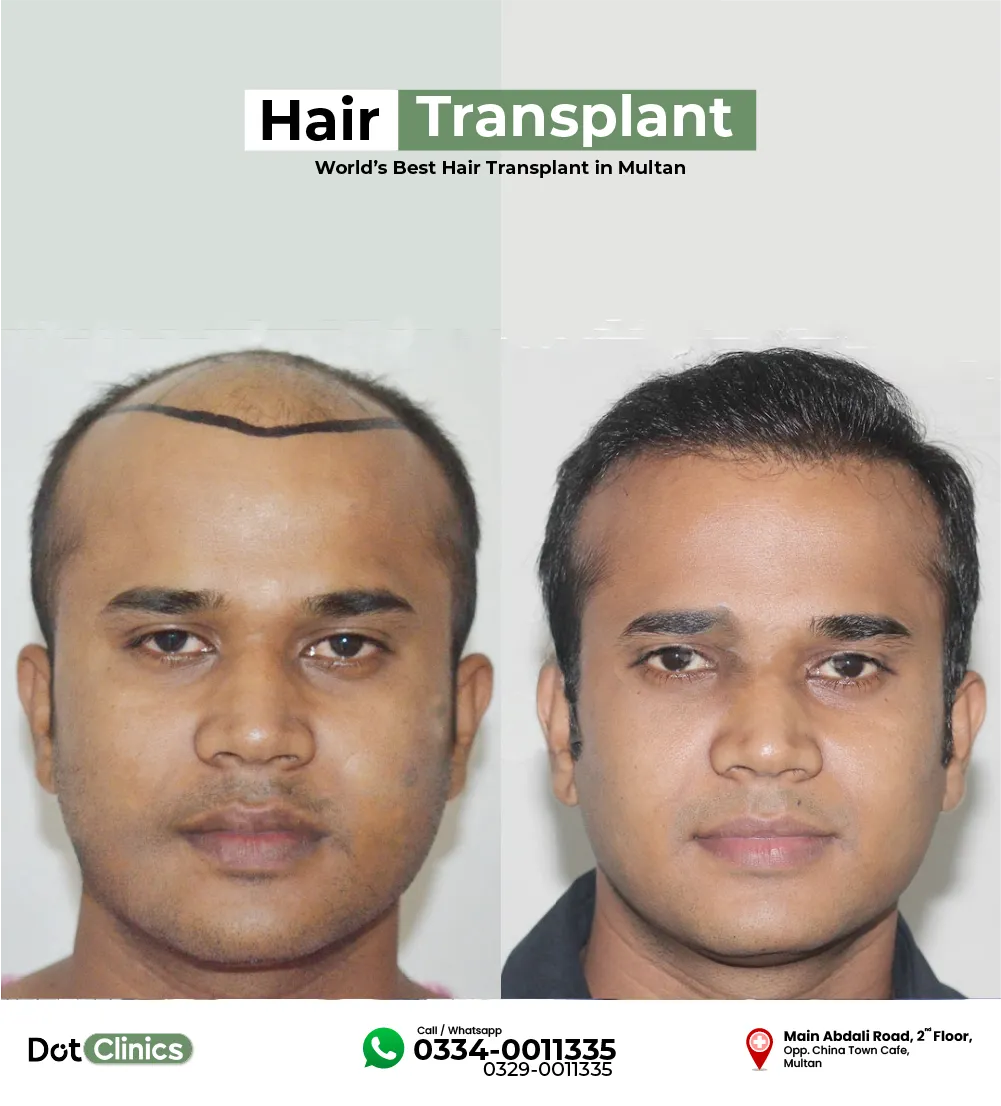 patient after 9 months of hair transplant surgery