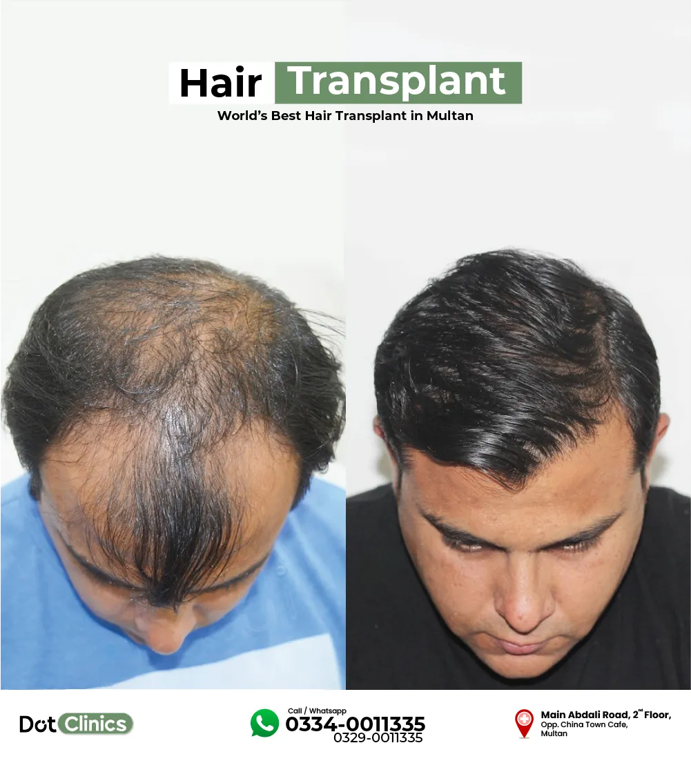 hair transplant pakistani patient after 10 months of surgery