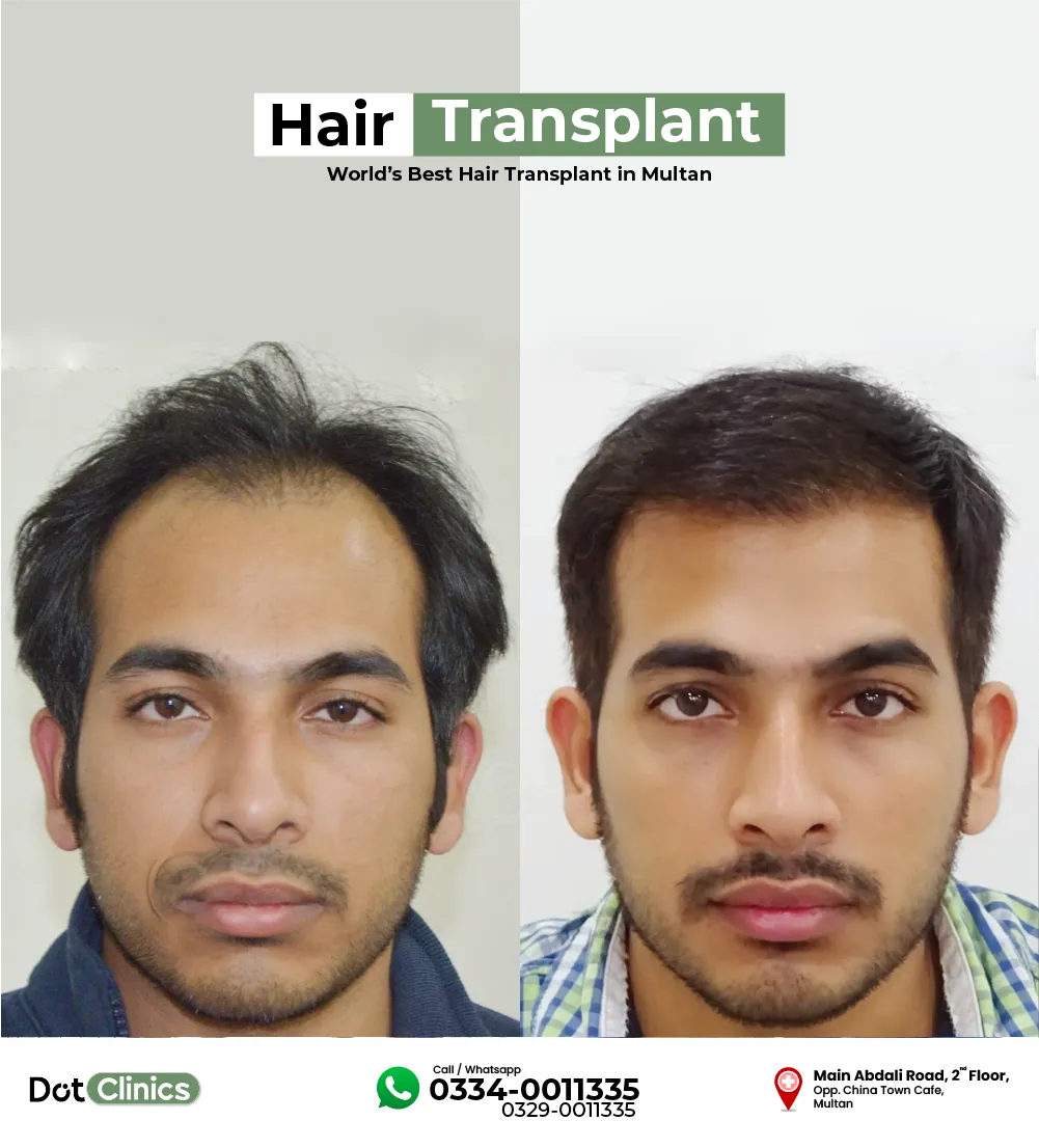 hair transplant pakistani patient before after 11 months