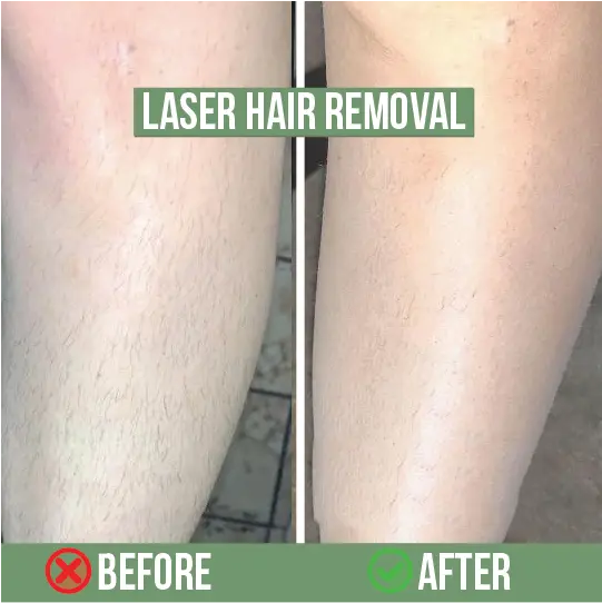 Laser hair removal legs before and after results – smooth skin
