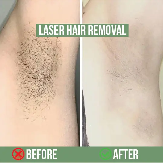 Underarm laser hair removal before and after – hair-free results