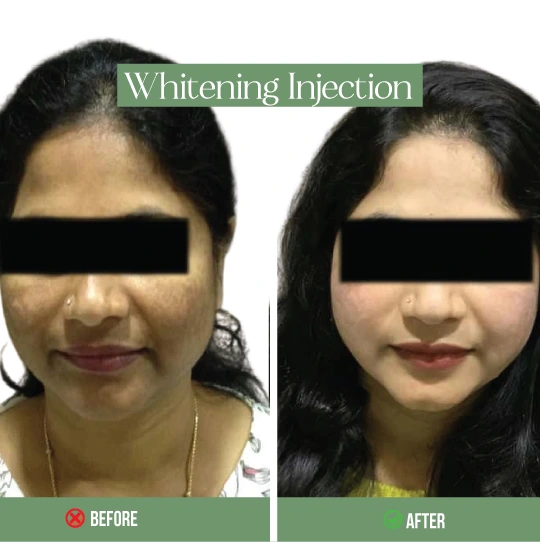 Whitening injection before and after results – skin brightening treatment for women