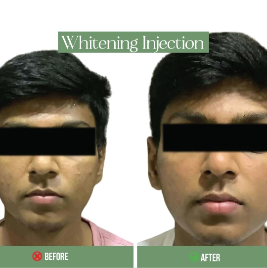 Whitening injection before and after results – skin lightening treatment for men