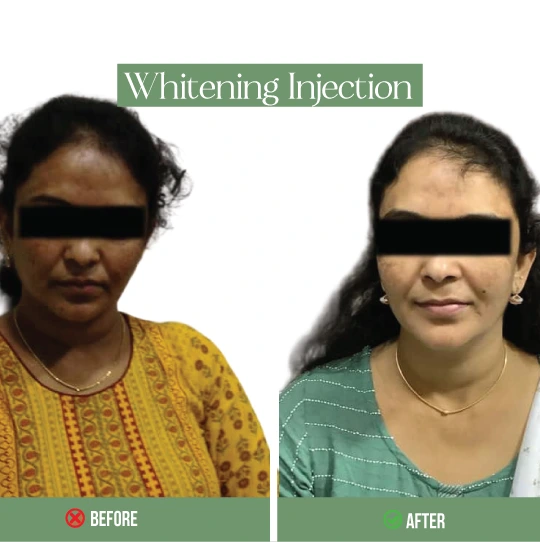 Whitening injection before after – visible skin whitening results for women