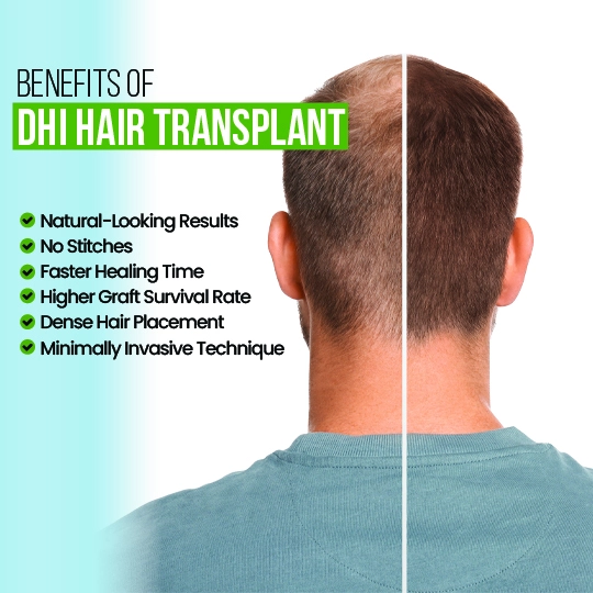 Before and after DHI hair transplant showing natural-looking results, no stitches, faster healing, higher graft survival, and dense hair placement.