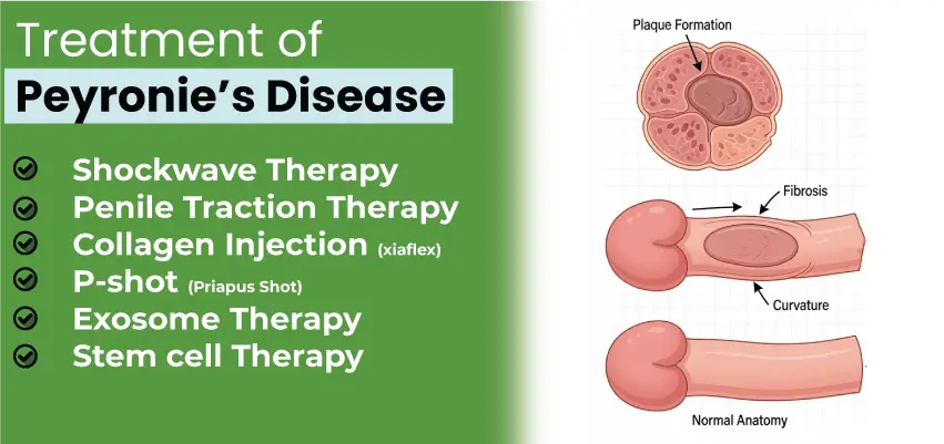 Medical illustration of Peyronie's disease treatments including shockwave therapy, penile traction, P-shot, and stem cell therapy.
