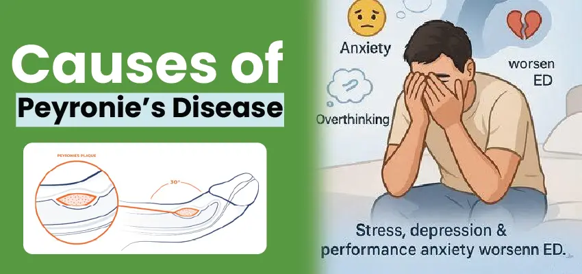 Infographic showing Peyronie's disease causes: plaque buildup diagram and psychological factors like anxiety