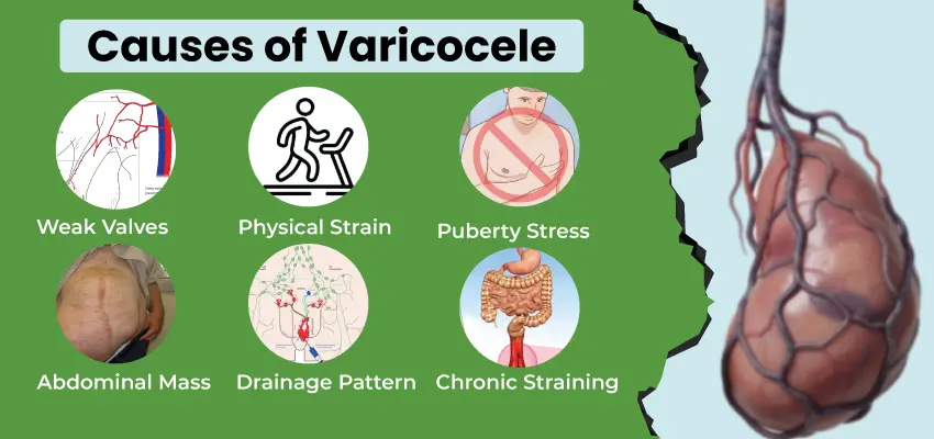 Infographic showing six causes of varicocele with icons and an enlarged testicle illustration