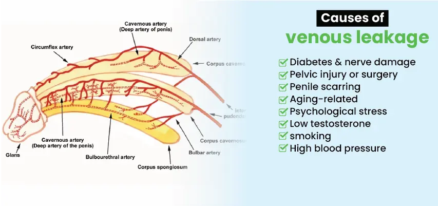 Anatomical diagram showing penile blood vessels and list of venous leakage causes including diabetes and aging