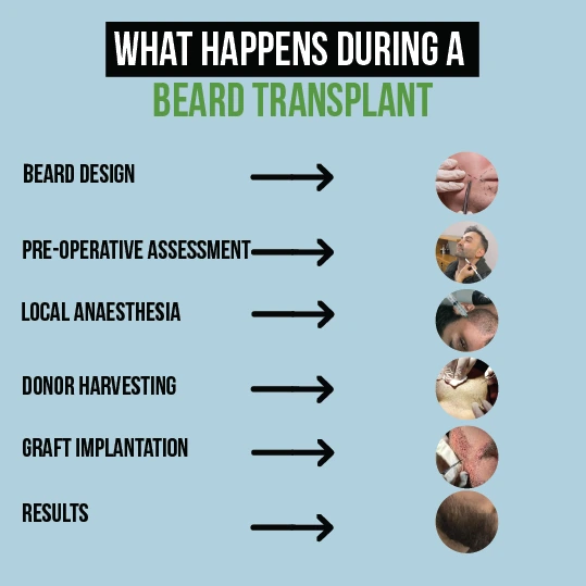 Step-by-step infographic showing the beard transplant process from design to results.