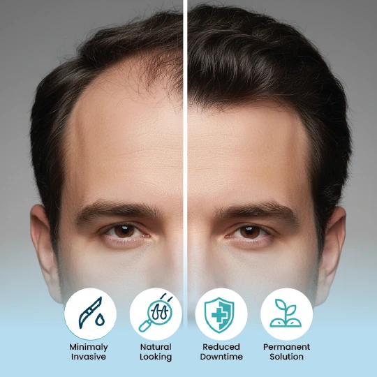 FUE hair transplant before & after – natural, permanent results with minimal downtime.