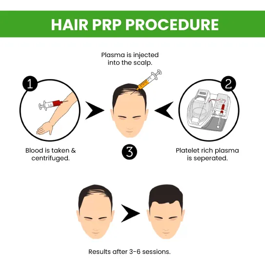 hair prp procedure