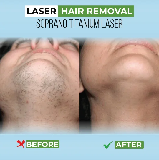 Laser hair removal chin before after using Soprano Titanium laser for smooth skin