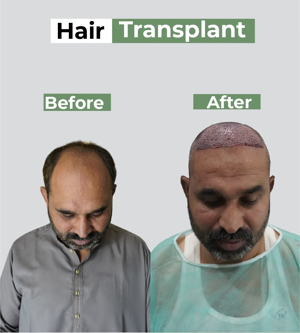 Hair transplant before-after: receding hairline and thinning crown restored to fuller hair density