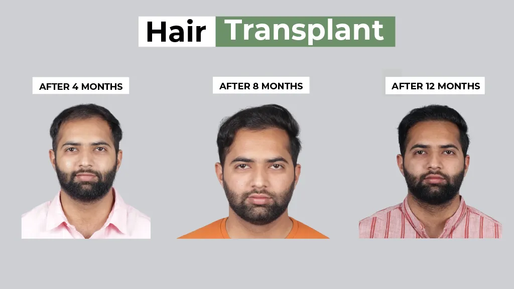 Hair Transplant Before and After Results Timeline Hair transplant before and after results showing monthly hair growth progress for 12 months
