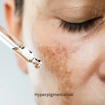 hyper-pigmentation-at-dot-clinics Close-up of patient with facial mole being examined by dermatologist with magnifier
