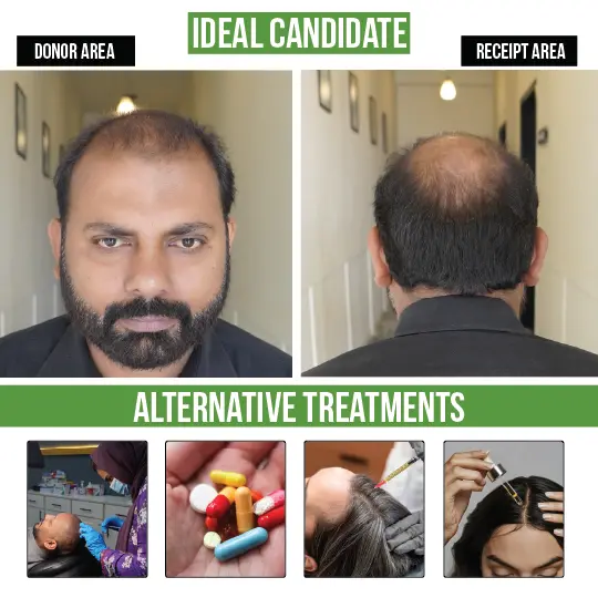 Ideal candidate for hair transplant showing donor and recipient area