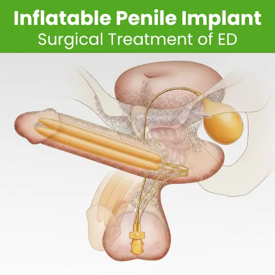 Medical illustration showing the internal placement of an inflatable penile implant for ED