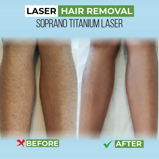 Leg laser hair removal before after comparison showing smooth, hair-free results