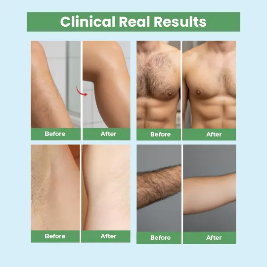 Clinical laser hair removal before-after results on arms, chest, legs showing smooth hairless skin