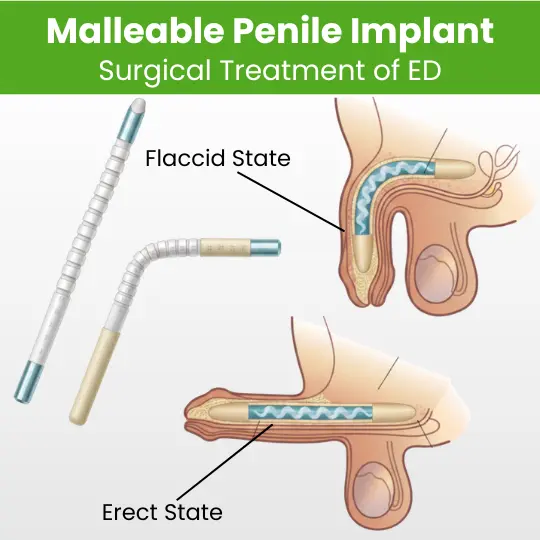 Diagrams showing flexible malleable penile implant working in flaccid and erect penile states.