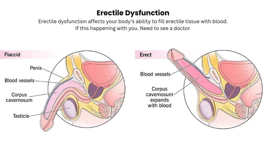 erectile dysfunction