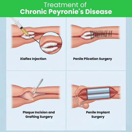 Chronic Peyronie's disease surgery: Plication, grafting, and penile implant procedures.