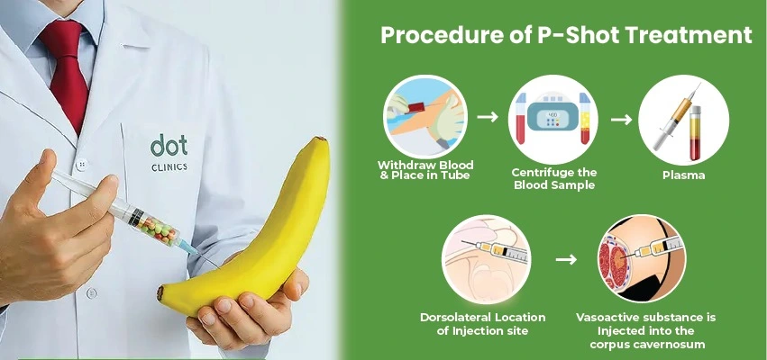 P-Shot procedure steps diagram showing blood draw to plasma injection