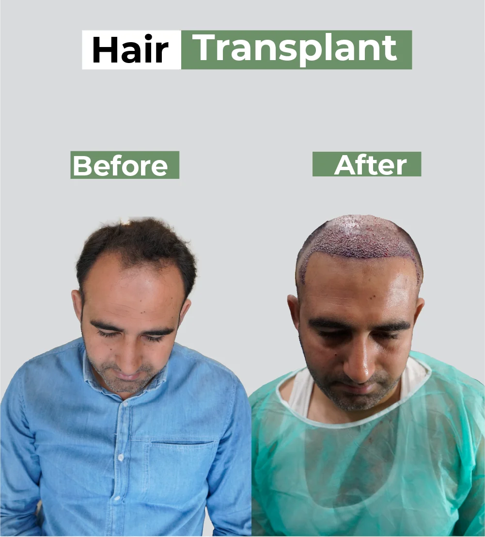 Hair transplant before-after: severe crown baldness restored to dense hair coverage post-surgery result