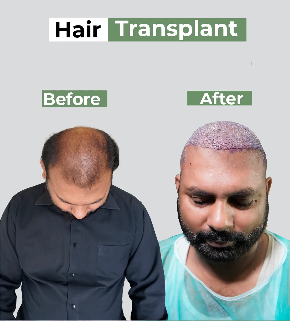 Hair transplant before-after: male pattern baldness transformed to full hairline with surgical restoration