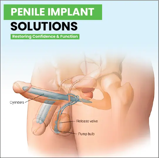 Medical diagram showing penile implant components including cylinders, pump bulb, and valve