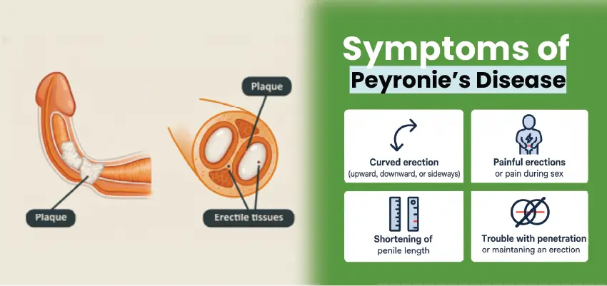 Peyronie's disease symptoms: curved erection, painful erections, penile shortening, and penetration issues