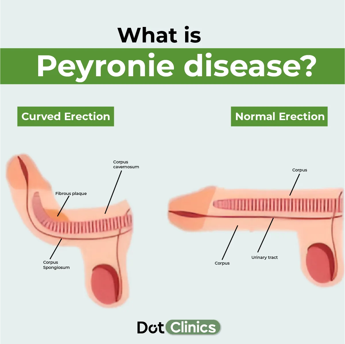 what is peyronies