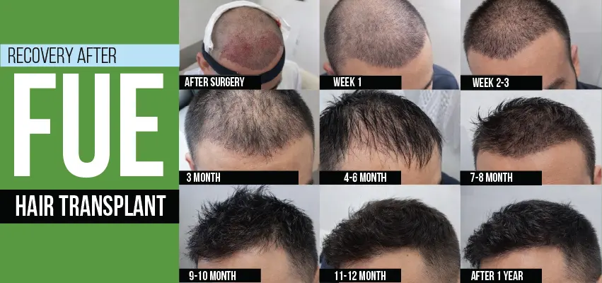 FUE hair transplant recovery timeline showing progress from surgery to 1 year