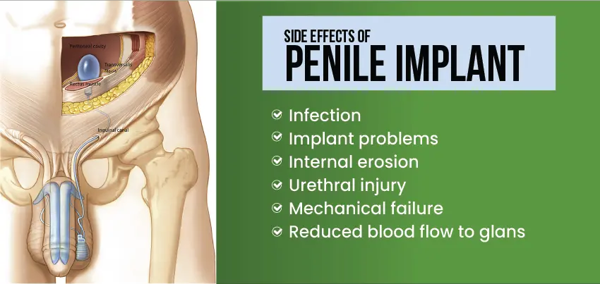 Medical diagram showing anatomical cross-section of penile implant device with list of potential side effects