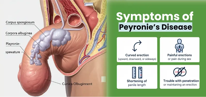 Diagram showing Peyronie's disease symptoms: curved erection, painful erections, penile shortening, and trouble maintaining an erection.