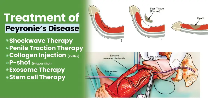 Treatment options for Peyronie's disease including shockwave therapy, injections, and surgical procedures