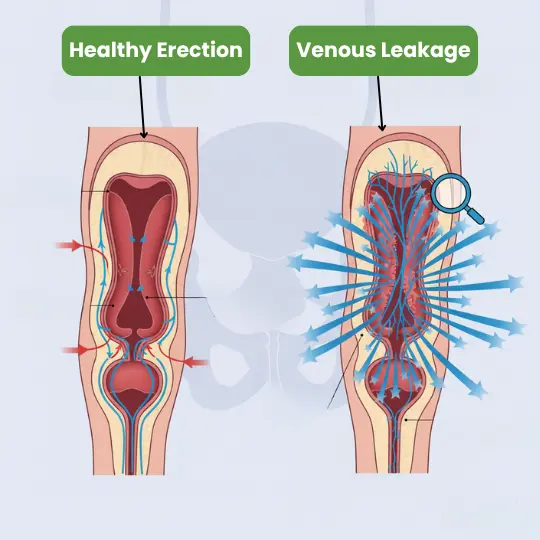 Venous leakage treatment at Dot Clinics restores erectile strength naturally.