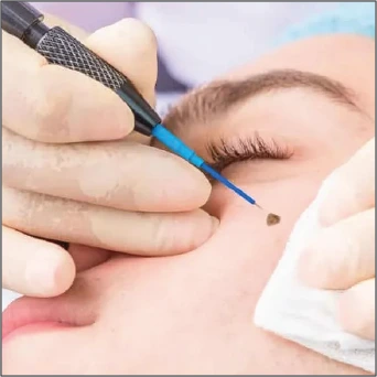 Wart & Moles removal and scalp treatment using advanced mesotherapy techniques