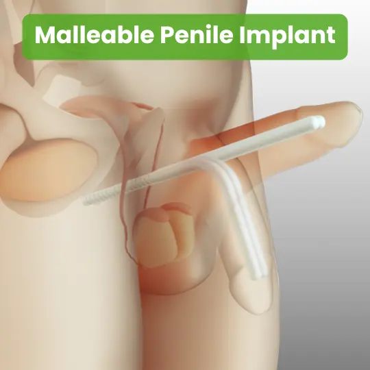 Anatomical illustration showing malleable penile implant positioned within the male body for ED