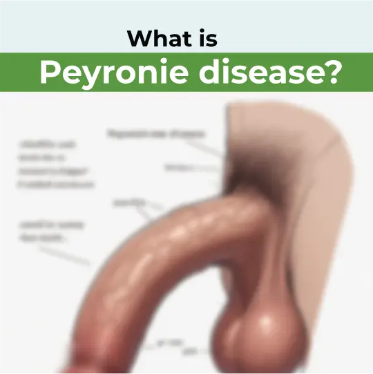 Medical illustration showing penile curvature caused by Peyronie's disease, a condition involving fibrous scar tissue buildup.