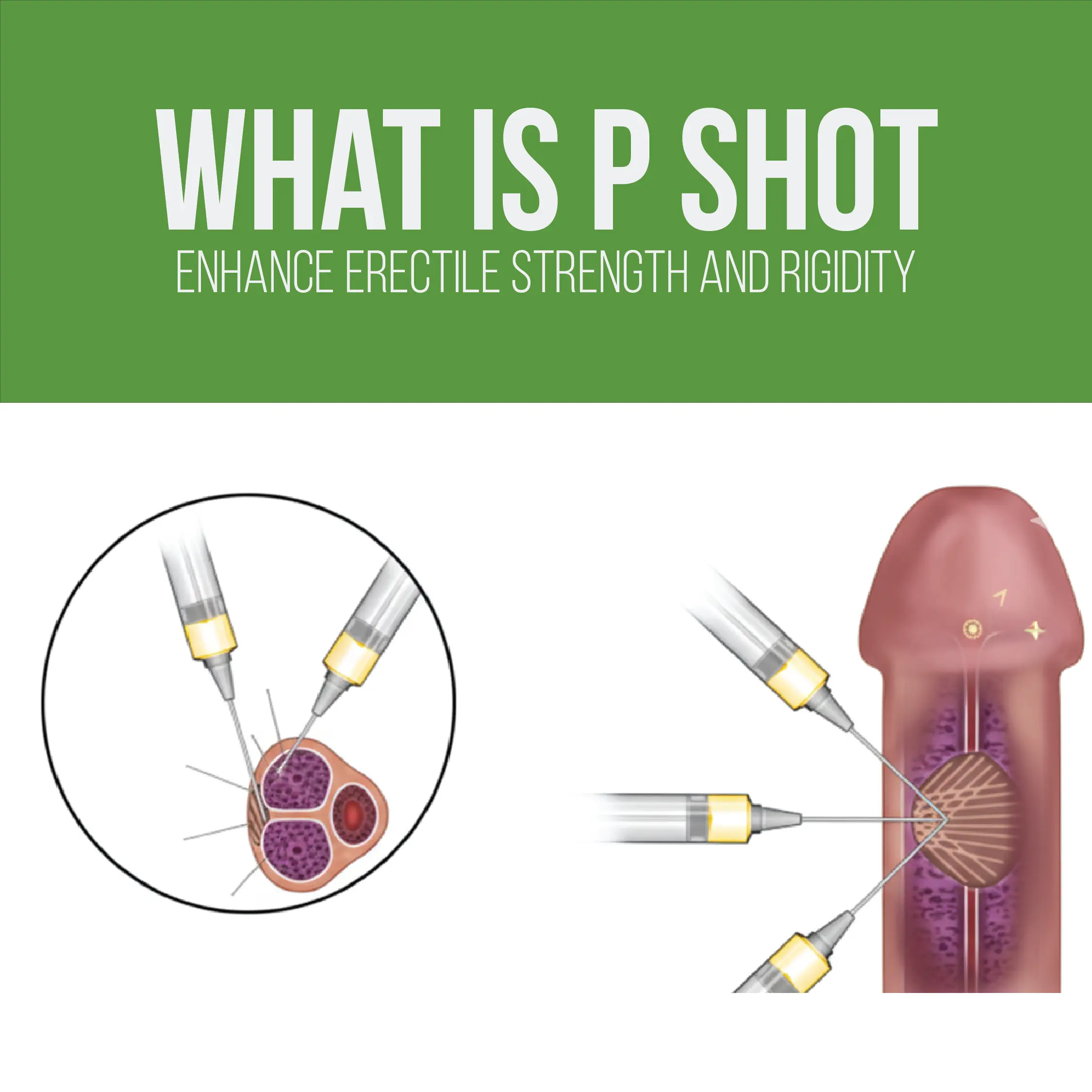 Diagram titled What is P Shot showing syringes injecting into an anatomical illustration.