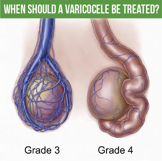 Medical illustration comparing Grade 3 and Grade 4 varicocele severity, showing enlarged scrotal veins with the heading When Should a Varicocele Be Treated?