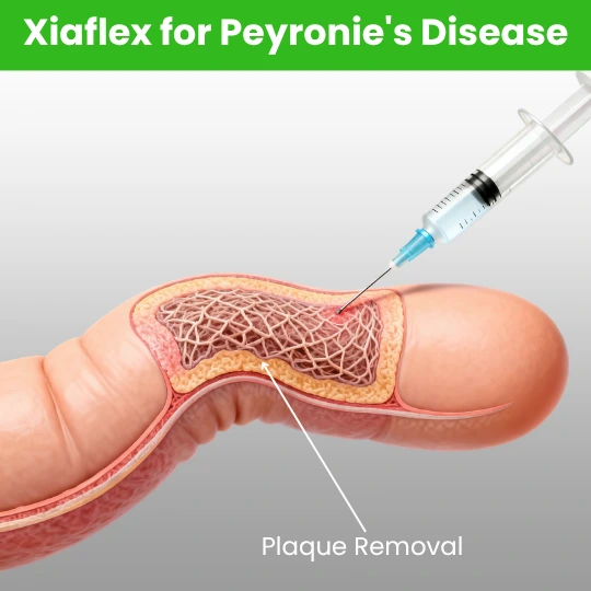 Xiaflex injection for Peyronie’s disease plaque removal and curvature correction.