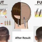 comparison procedure of FUE and FUT and Given after result
